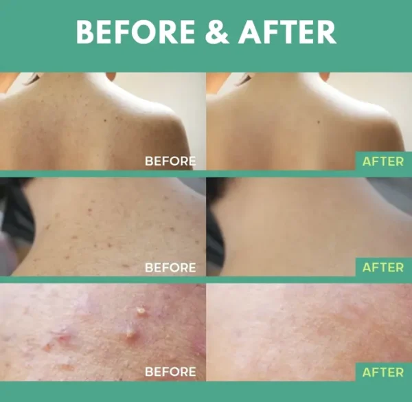 Body Acne Spray: Salicylic Acid, Tea Tree Oil & Niacinamide, 4 oz